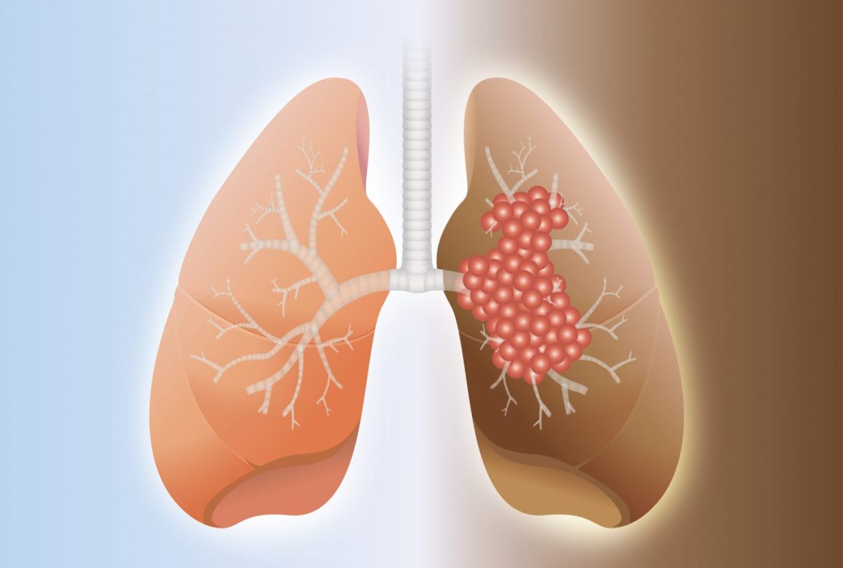 „M-am vindecat de fibroza pulmonară”: O dorință de după diagnostic
