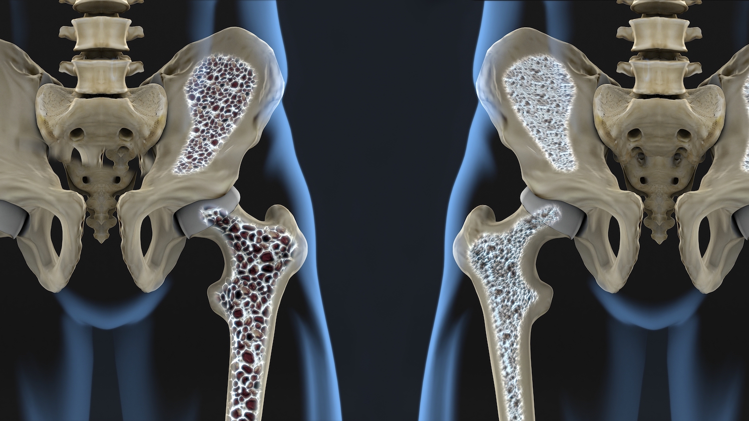osteoporoza la nivelul bazinului radiografie