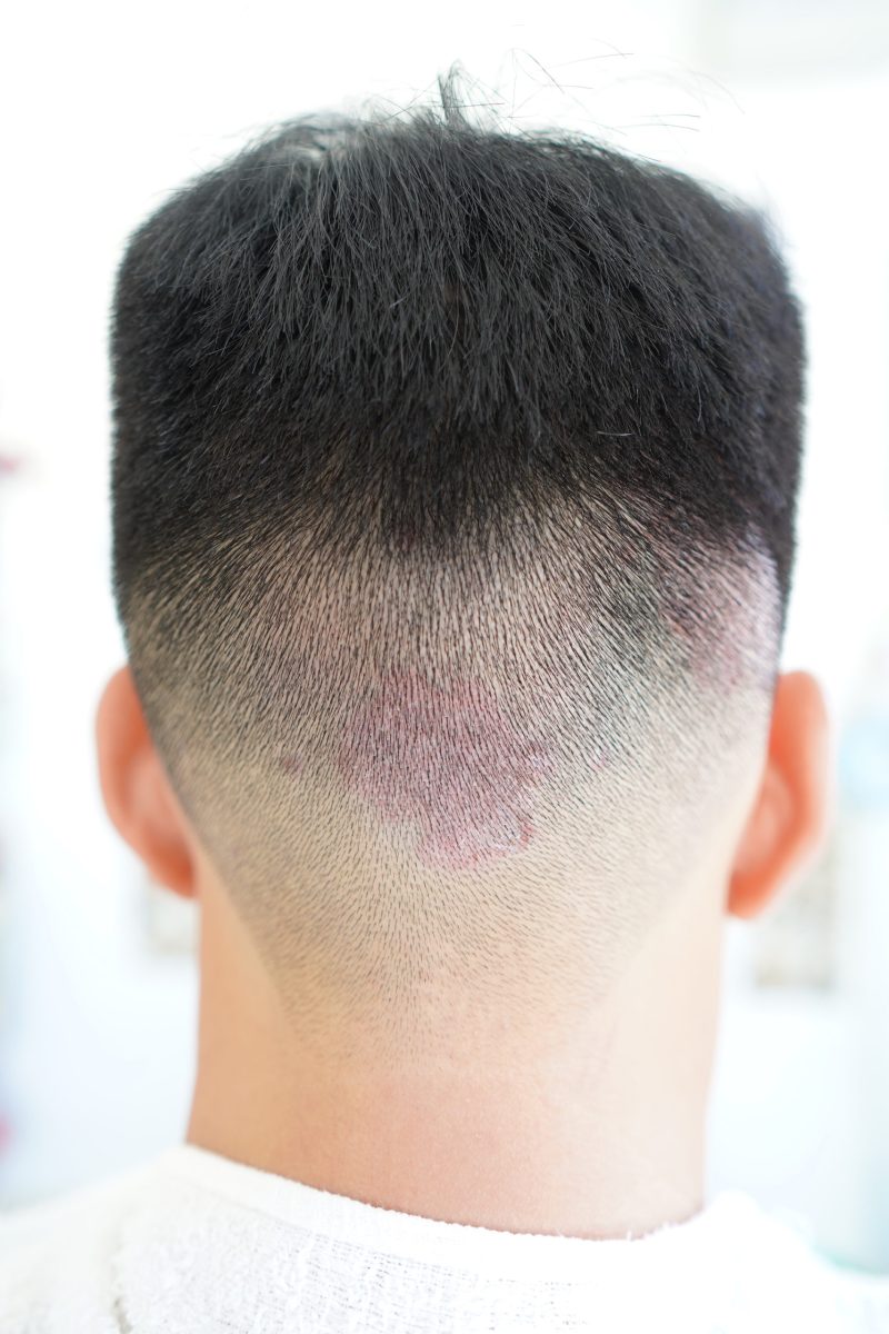 Psoriazis scalp: Simptome și tratament