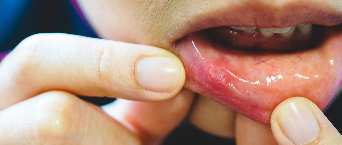 inflamatie la nivelul buzei unui copil