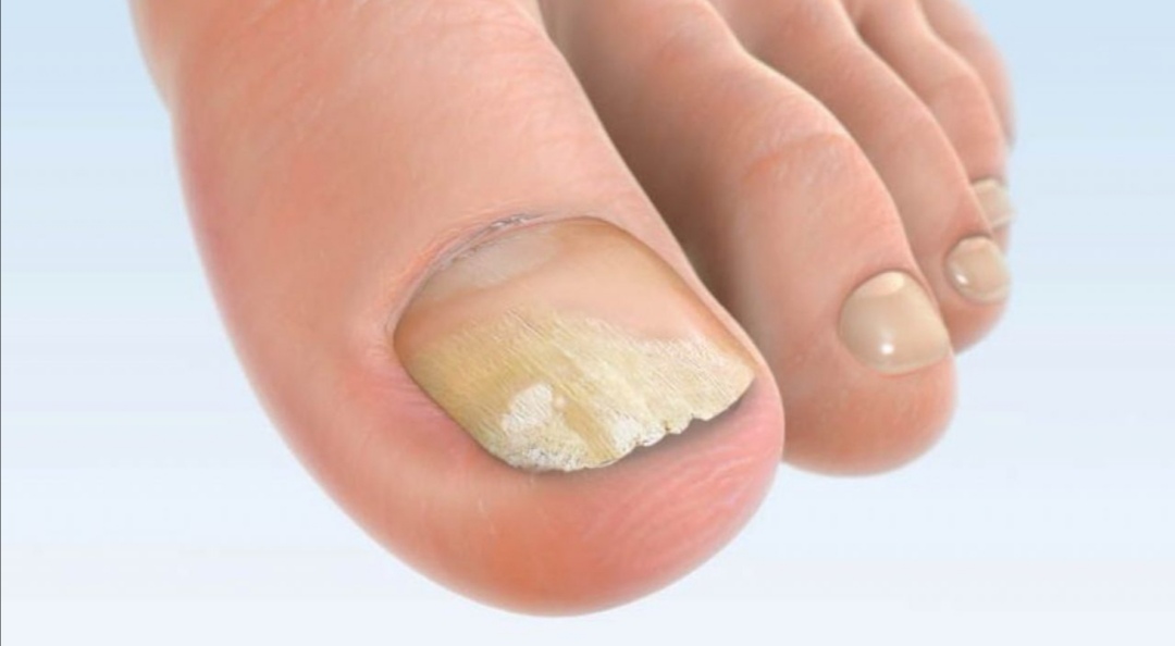 Cel mai bun tratament pentru ciuperca unghiei și a piciorului