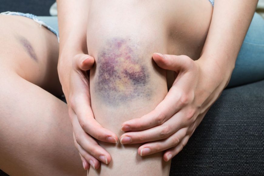 Purpura trombocitopenică autoimună: Ce este, simptome și tratament