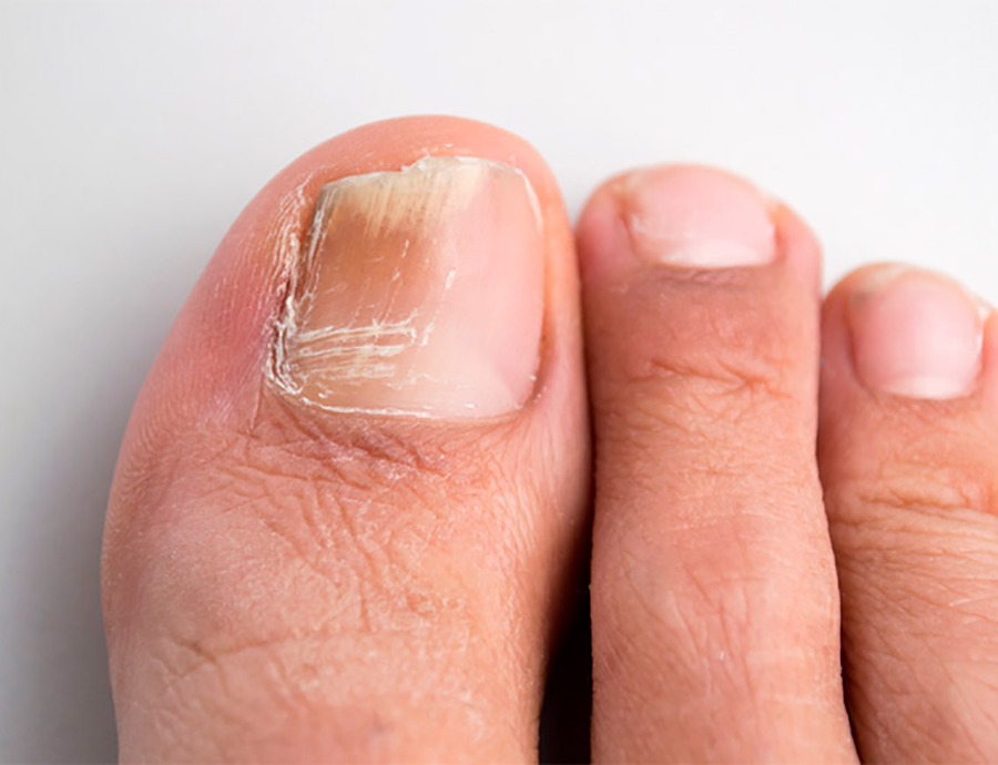imagine ciuperca unghiilor de la picioare