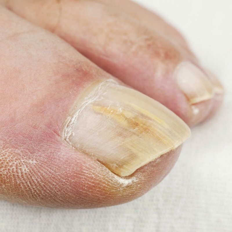 boli fungice ale unghiilor