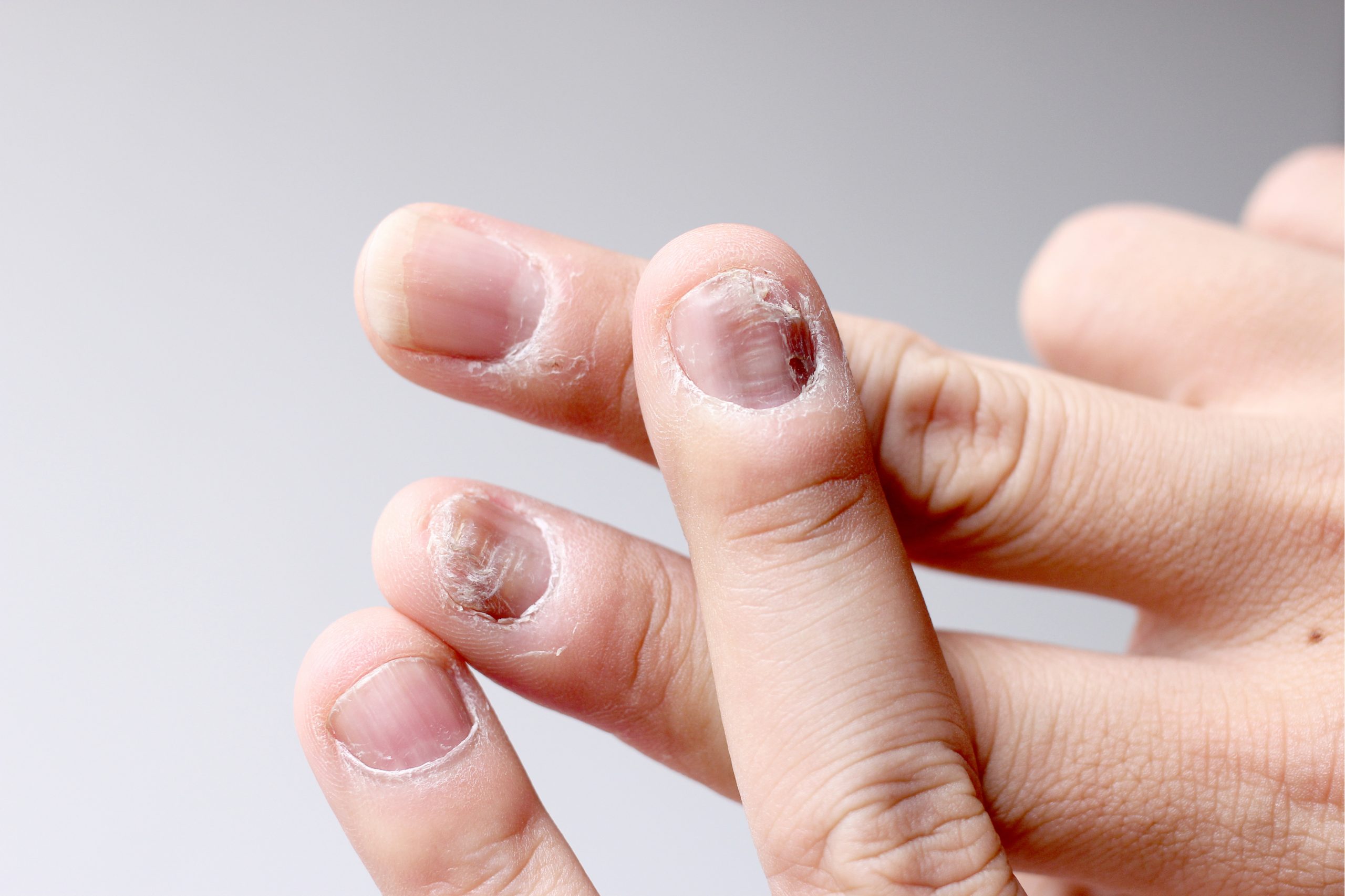 cum să tratezi o unghie afectată de o ciupercă în