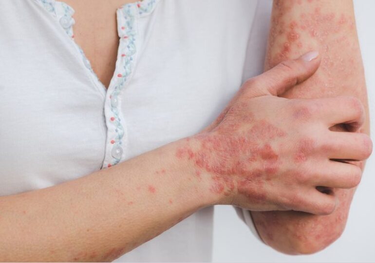 Leacuri bătrânești pentru psoriazis – Remedii naturiste pentru această afecțiune