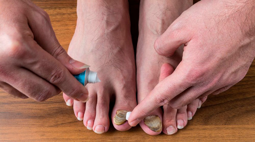 tratament cu iod și ciuperca unghiilor modalități de a trata ciuperca unghiilor și picioarelor
