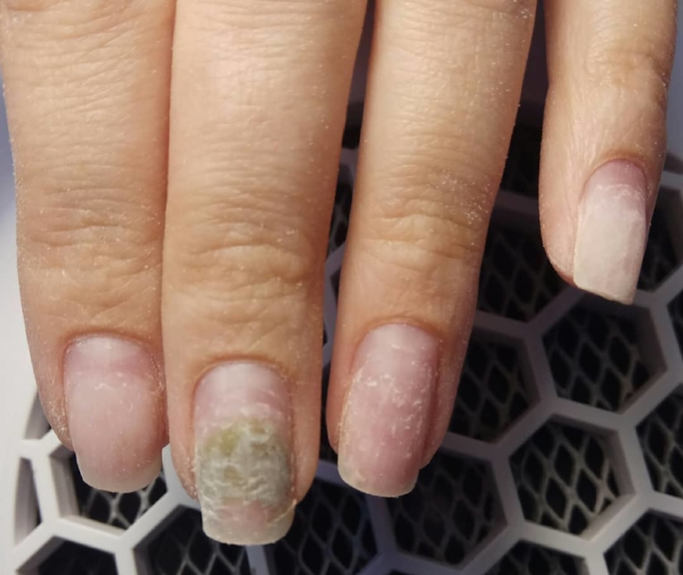 ciuperca mucegăită pe unghiile picioarelor