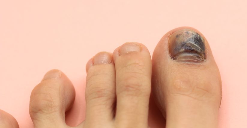 Ciuperca piciorului și a unghiilor: simptome, metode de tratament și metode de prevenire