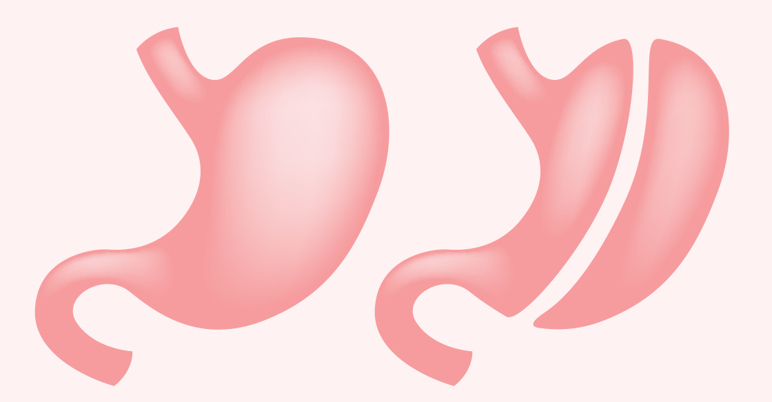 Avantajele și dezavantajele operației de micșorare a stomacului: Află totul despre gastric sleeve