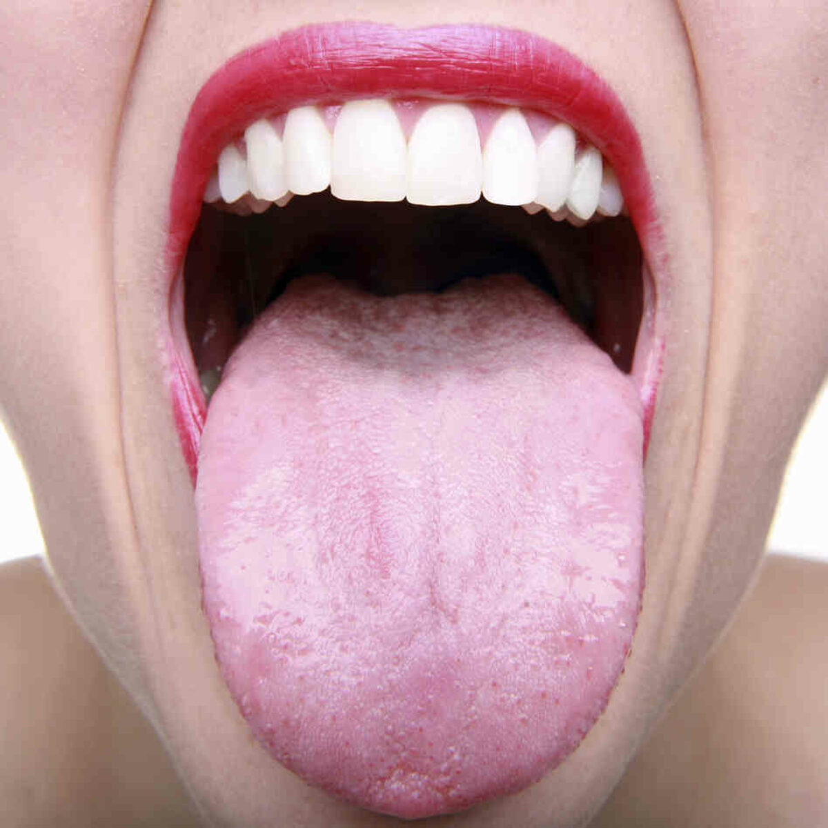 femeie cu gura cascata si cu limba afara care sufera de candida