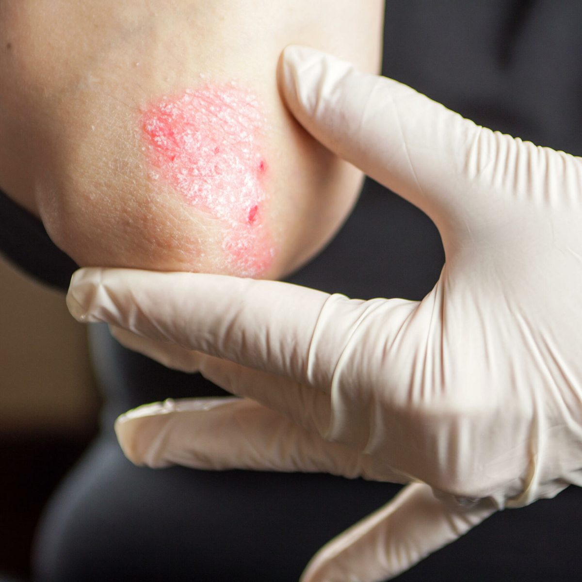 Tipuri de psoriazis poze: Principalele cauze care provoacă boala