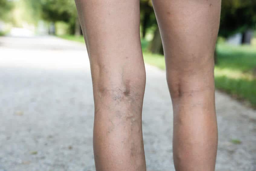 Tratament pentru varice: Remedii naturiste simple și eficiente
