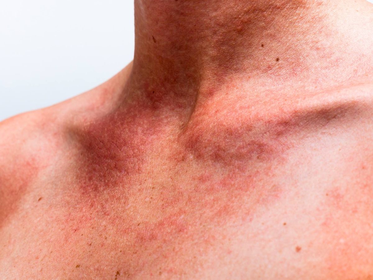 Alergia la căldură imagini. Cum să acționezi la timp pentru a reduce disconfortul