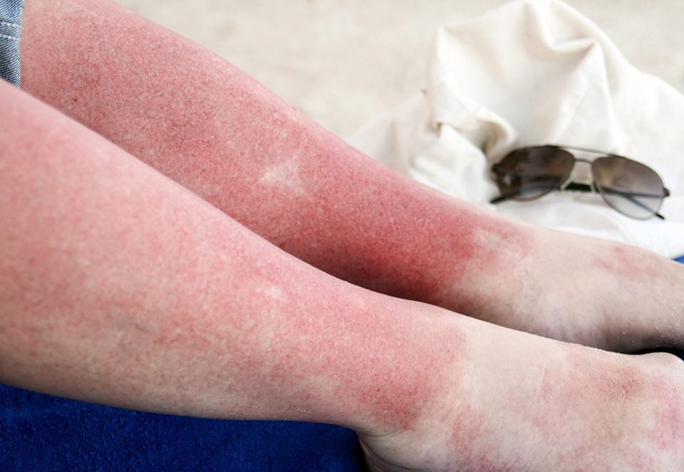 picioarele rosii a unei persoane din cauza celulitei infectioase