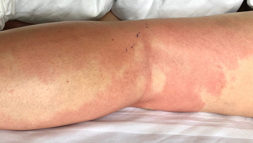 Celulita infecțioasă. Primele semne care îți indică această problemă de sănătate