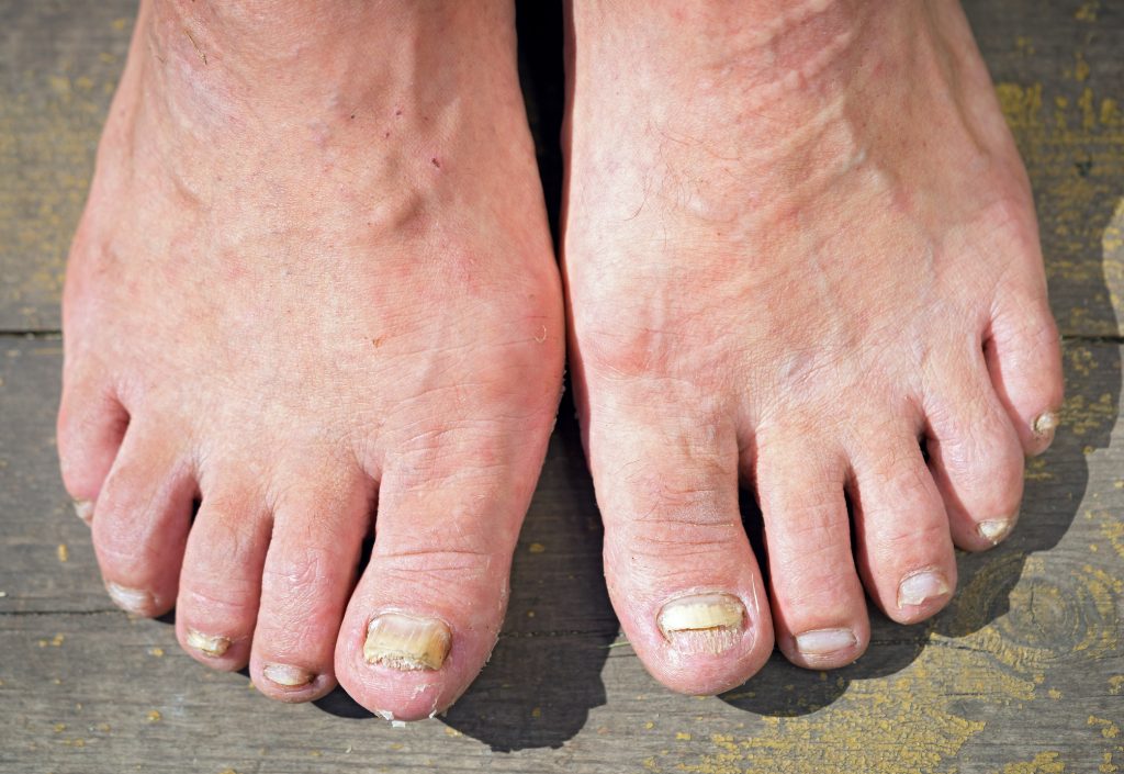 tratamentul cu oțet al pantofilor pentru ciuperca unghiilor