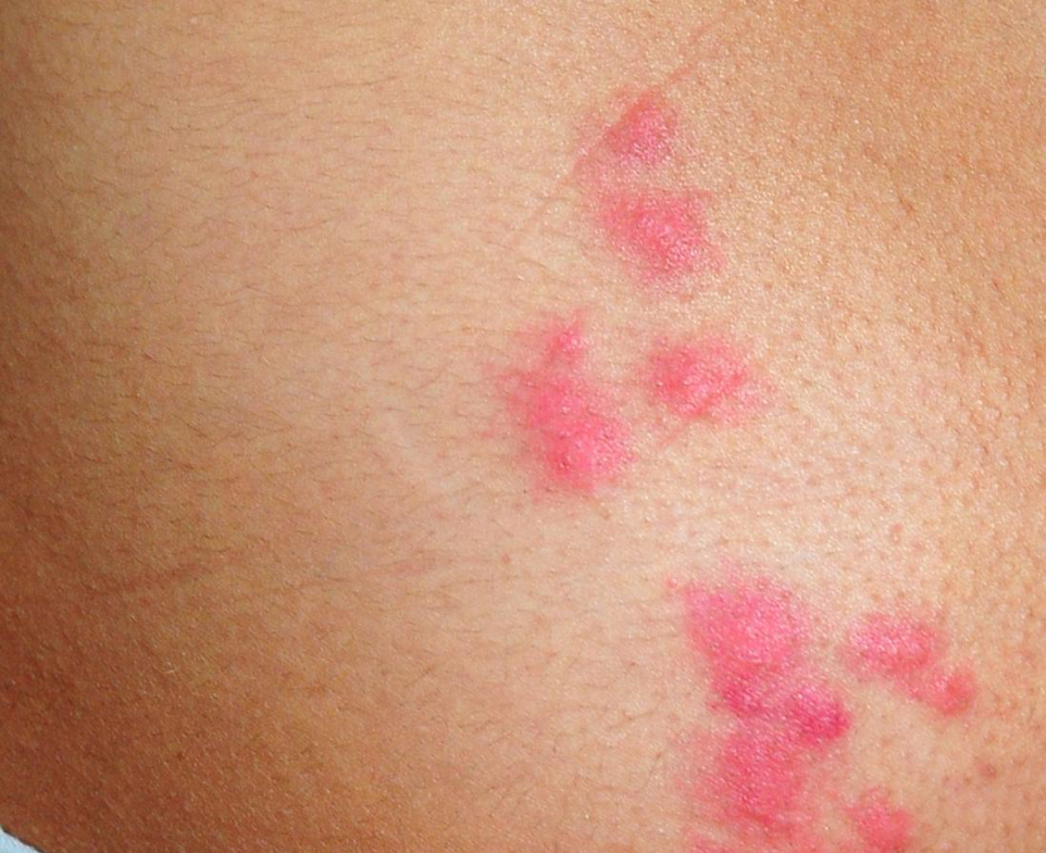 Ciupitura de purice: Cum să identifici rapid mușcătura insectei