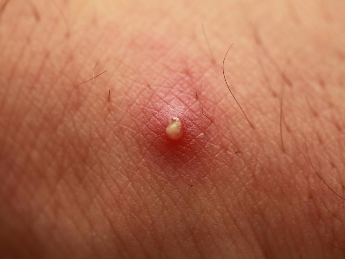 Tratament cu drojdie pentru furunculoză. Cele mai bune remedii care te scapă de furuncule