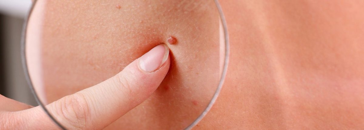 Imagini negi cancerigeni. Primele semne că suferi de virusul HPV