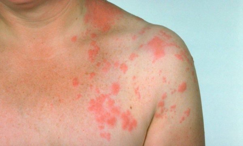 Tipuri de dermatită poze. Când debutează afecțiunea și cum să o identifici la timp