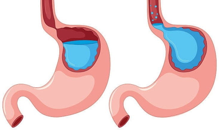 reprezentare a refluxului gastroesofagian