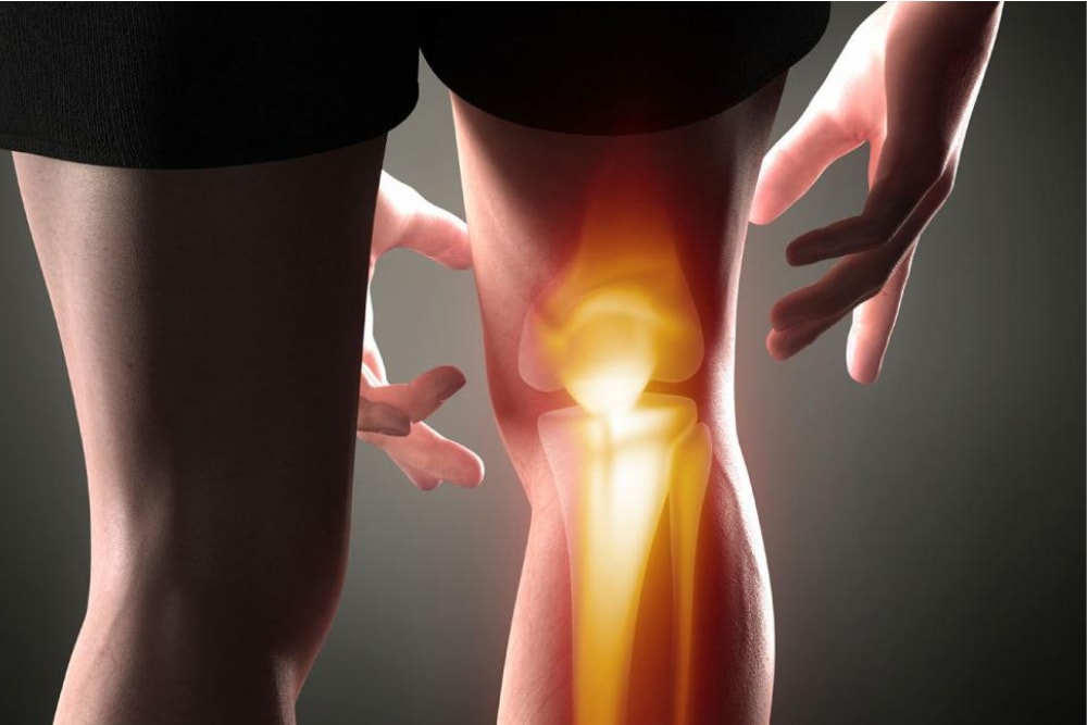 grafica genunchiul afectat de coxartroza a unei persoane