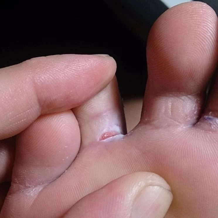 degetele de la picioare ale unei persoane afectate de ciuperca
