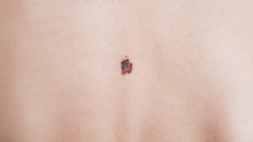 femeie care sufera de melanom benign pe spate