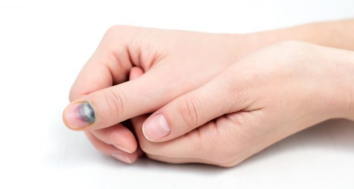 unghiile unei persoane care sufera de melanom