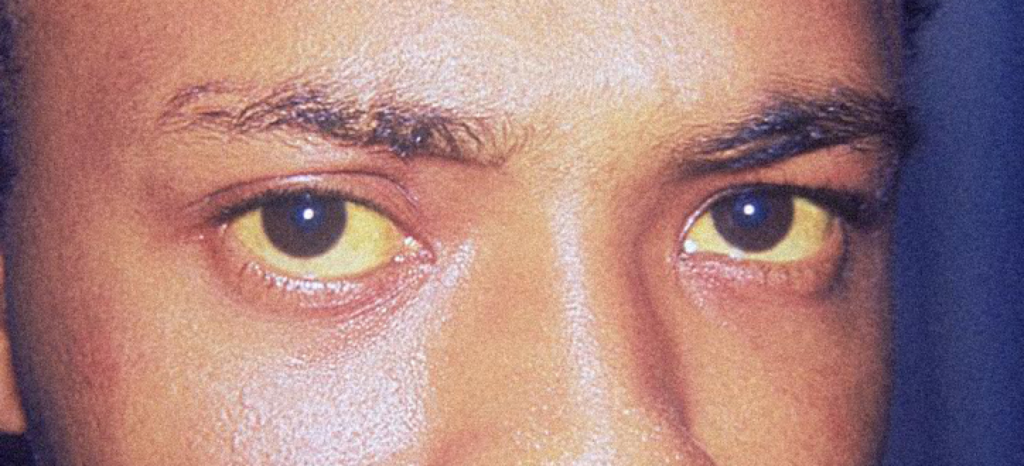 ochii galbeni a unei persoane