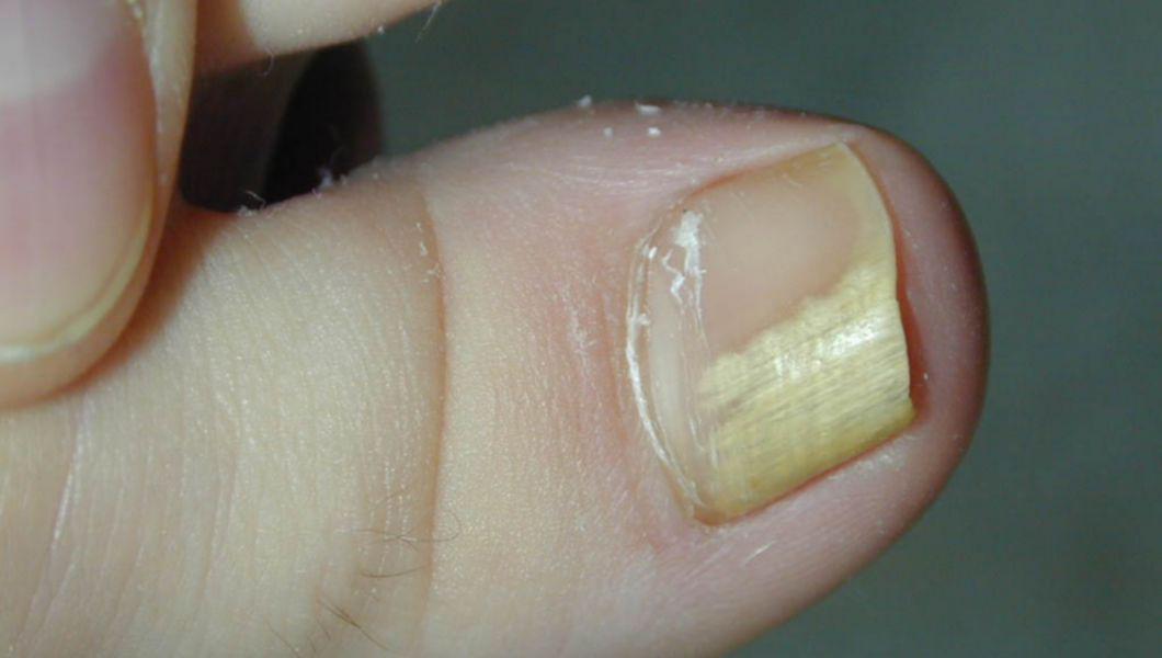 dezinfecție în apartament de ciuperca unghiilor cum să tratezi ciuperca unghiilor la pisici