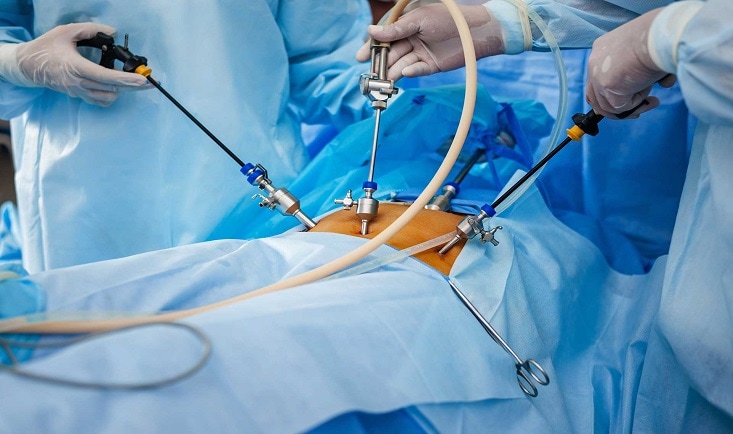 operație laparascopică hernie inghinală