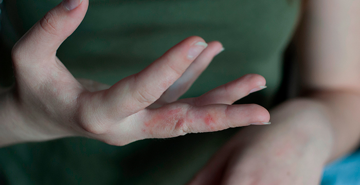 femeie care are eruptii pe degetele de la mana din cauza scabiei