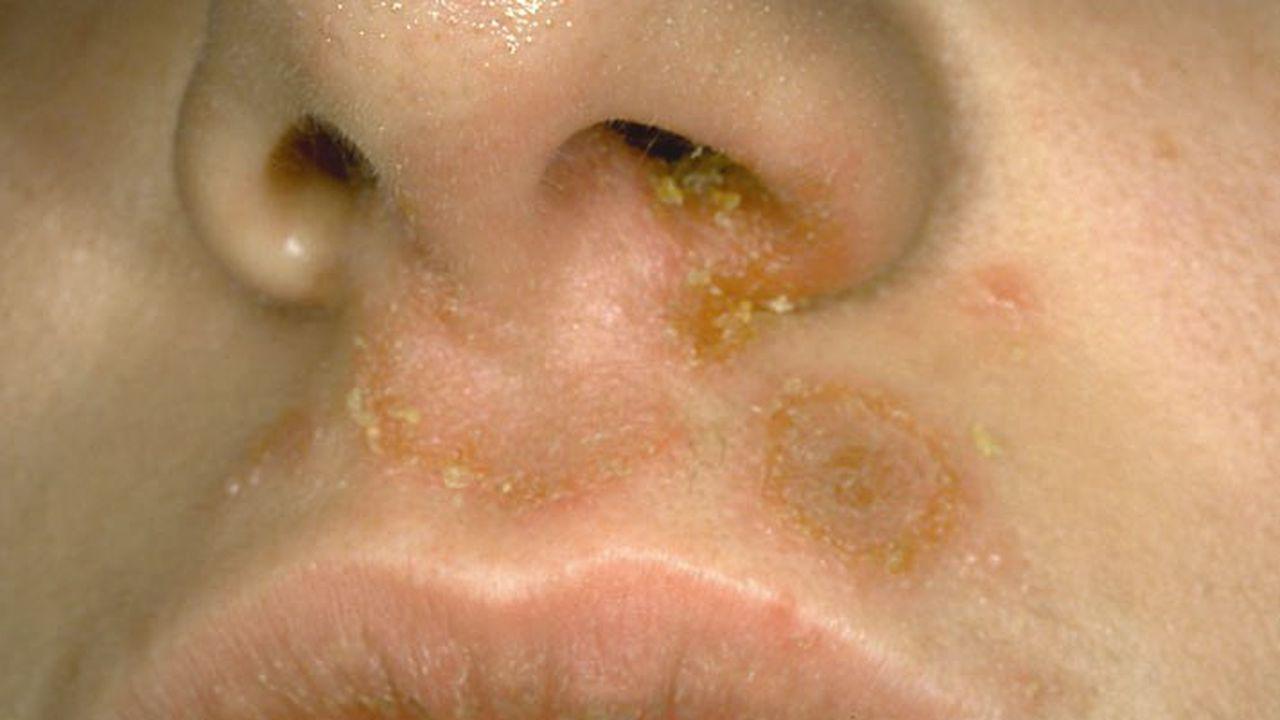 infectie cu stafiloco auriu în nas