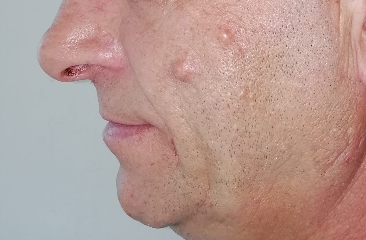 Chist sebaceu infectat. Cât de complicat este procesul de vindecare