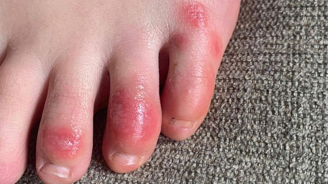 simptome ale ciupercii degetelor de la picioare și ale unghiilor gudron de mesteacăn împotriva ciupercii unghiilor