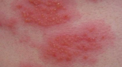 pete roșii provocate de dermatita atopica