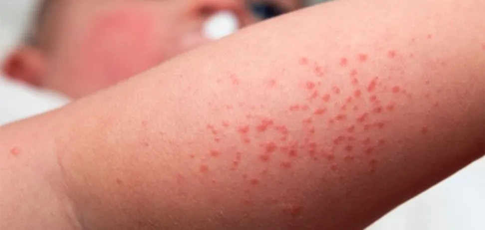 Dermatita atopică poze. Cum să previi o recidivă a bolii