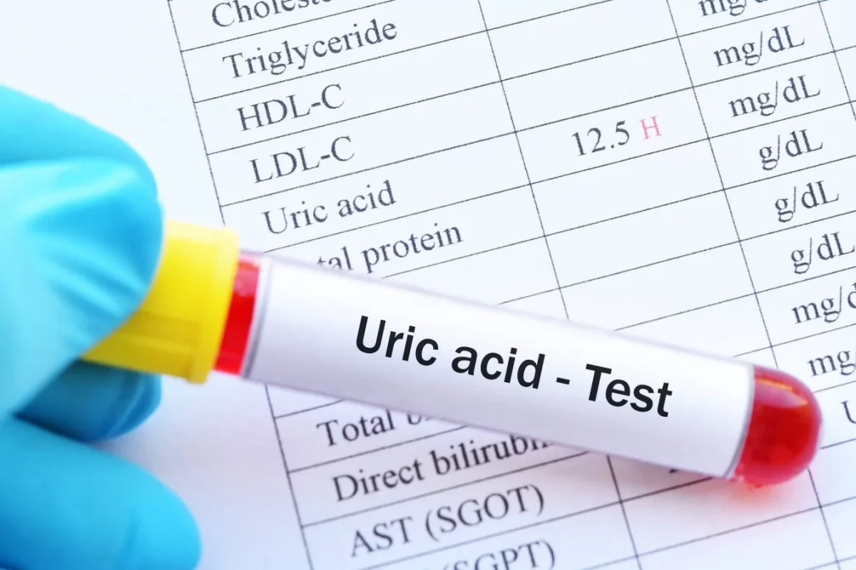 Eliminare acid uric tratament naturist. Cum să eviți formarea gutei și depunerile pe articulații