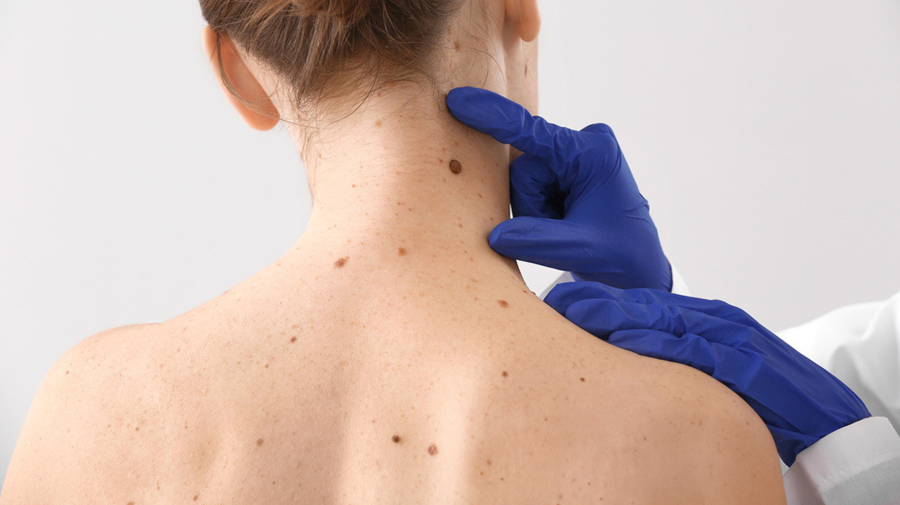 medic care analizeaza melanomul de pe spatele unei femei