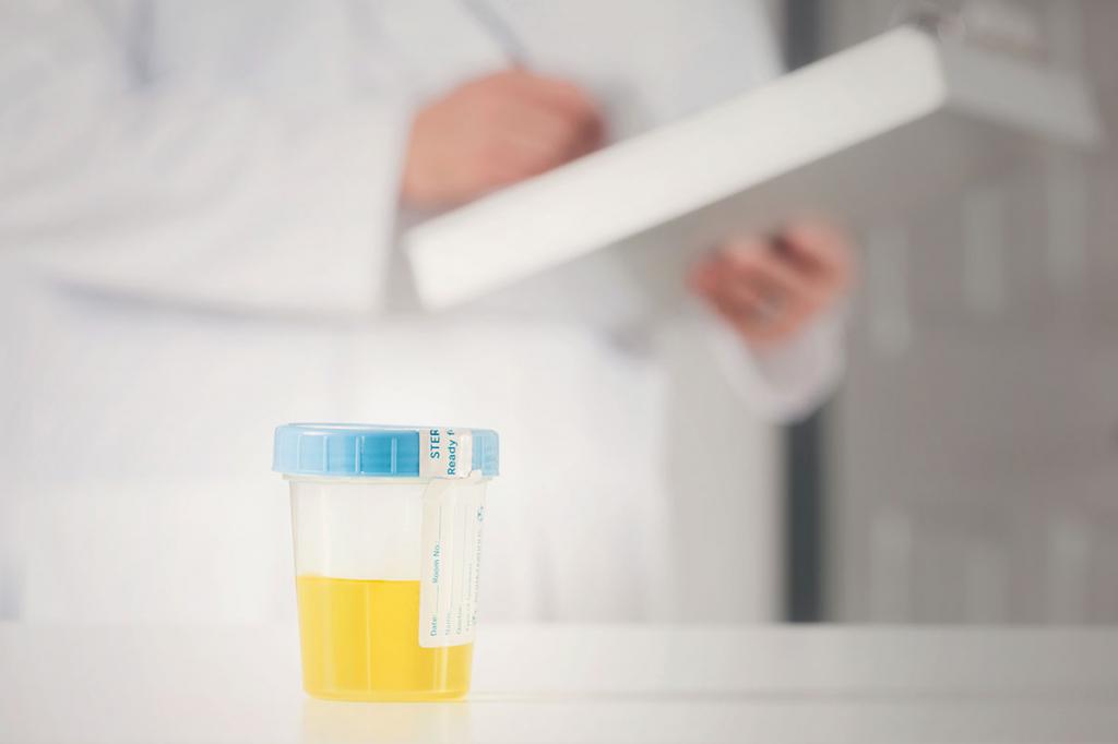 un recipient cu urina pe o masa si un doctor care analizeaza proba de urina