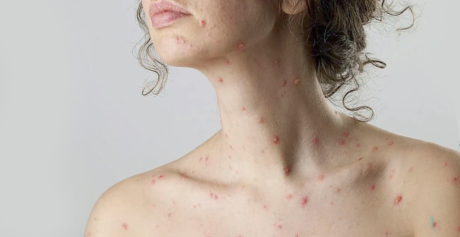 eruptii cutanate pe corpul unei femei provocate de varicela