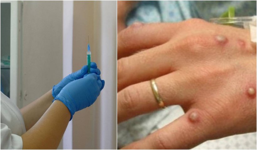 Primul caz de variola maimuței a fost depistat la un bărbat din București