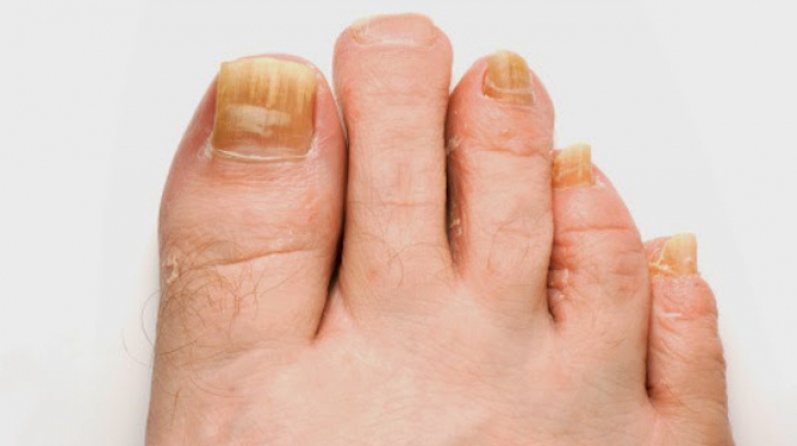 nou în tratamentul ciupercii unghiilor de la picioare