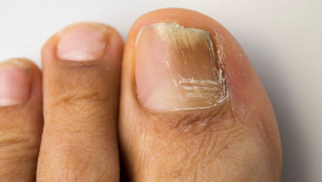 Cum să scapi de ciuperca unghiilor de la picioare rapid și permanent? - Funga Fix