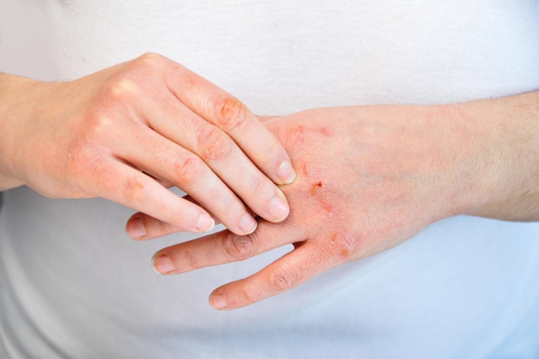 Psoriazis vulgar. Prin ce metodă poți scăpa de această boală autoimună