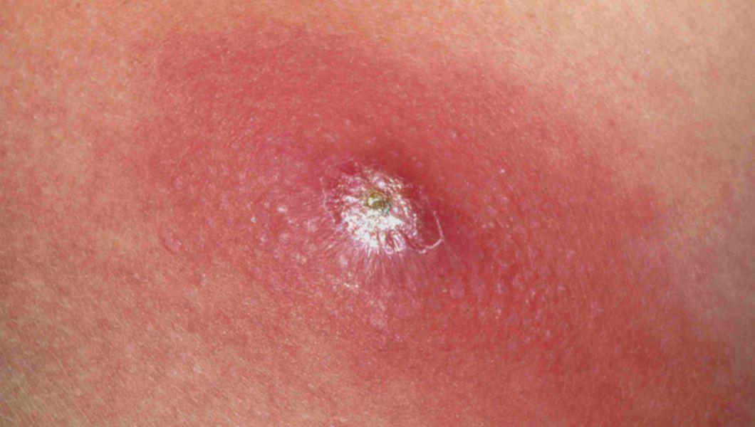 Infecția cu stafilococ auriu. Cauze, simptome, tratament și poze cu temuta bacterie
