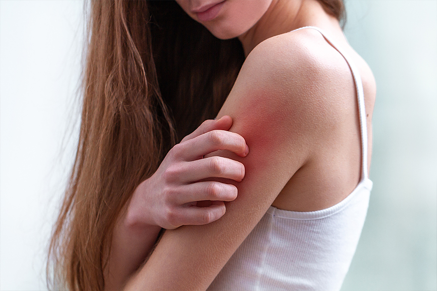 femeie care sufera de o alergie de piele pe sistem nervos si are mancarimi