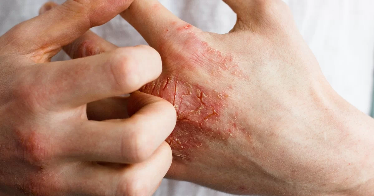 persoana care sufera de mancarimi pe maini provocate de eczeme